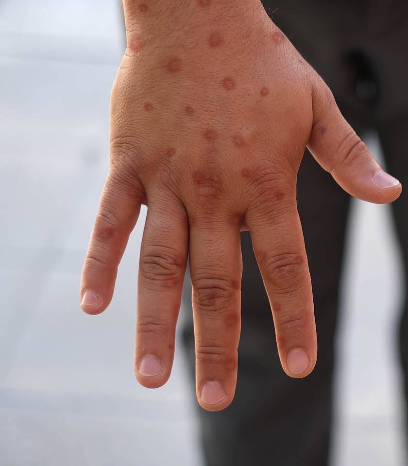Opičí neštovice (MPOX)