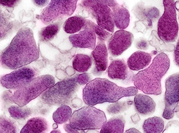 Otestujte se na Mycoplasma genitalium, možná ji máte a nevíte o ní, může být i příčinou neplodnosti